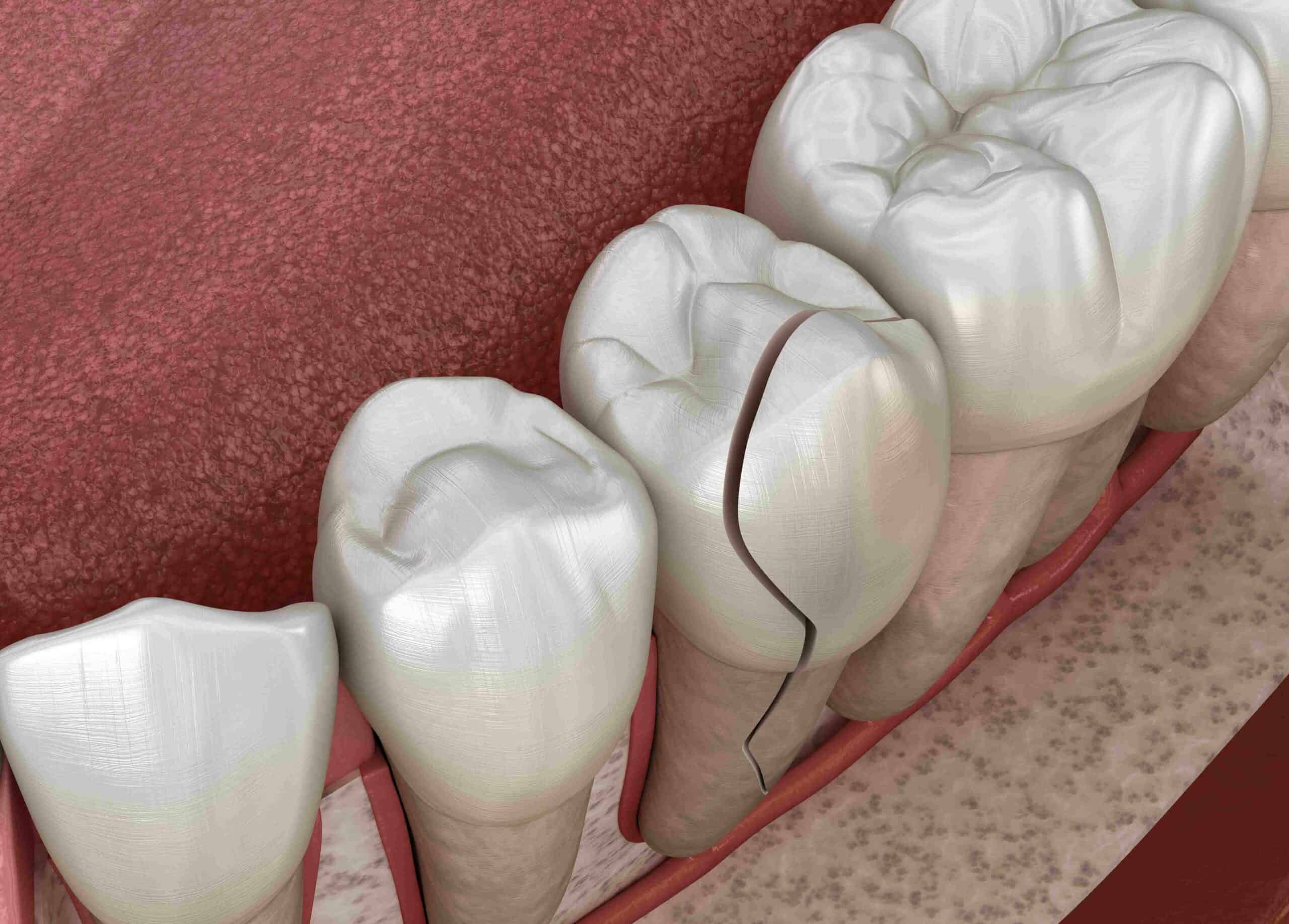 Cracked tooth, splitted. Medically accurate 3D illustration | Endodontic Specialists by Solomon Dental in Summerville, SC