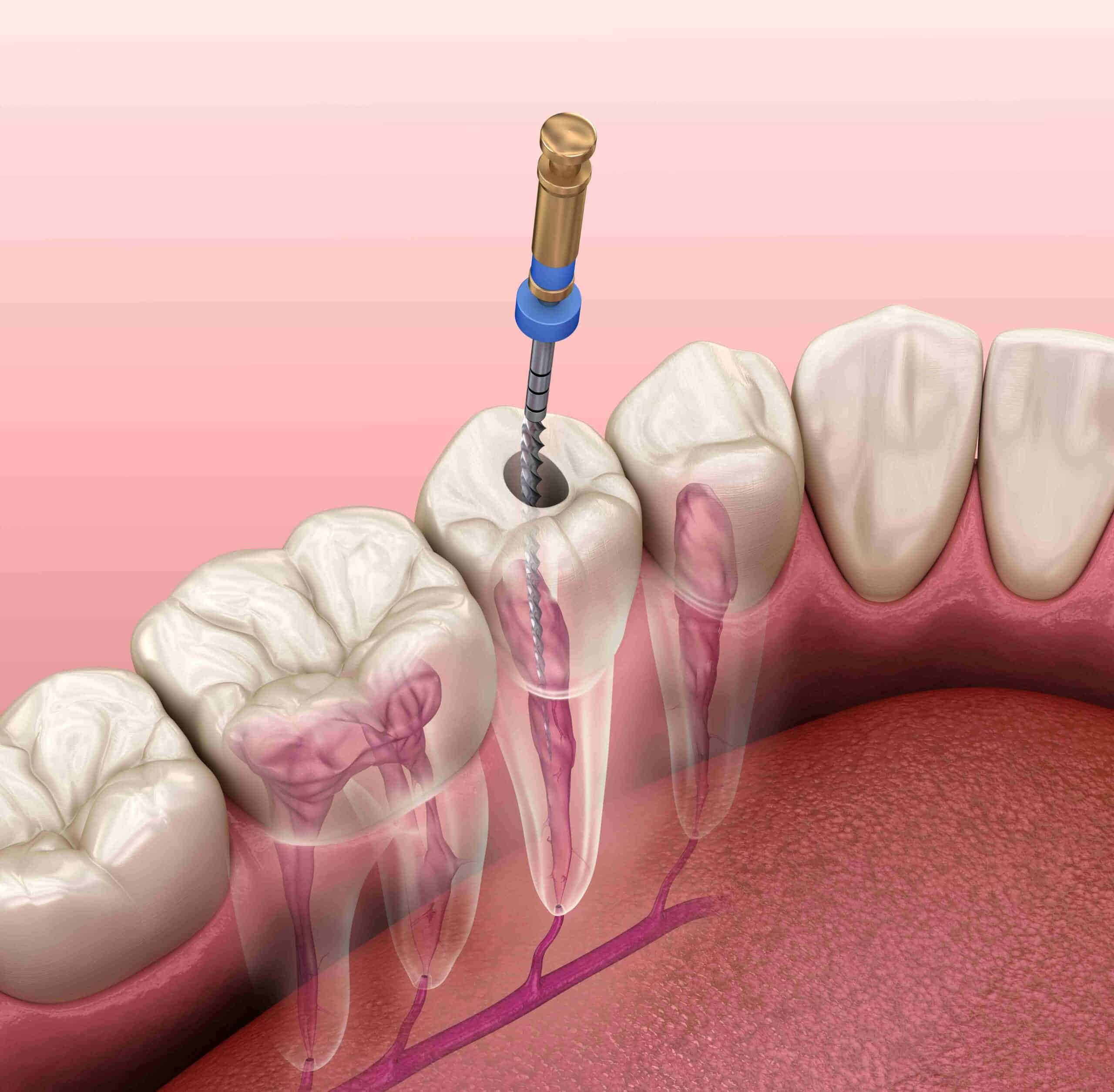 Root canal therapy Endodontics Specialists by Solomon Dental in Summerville, SC