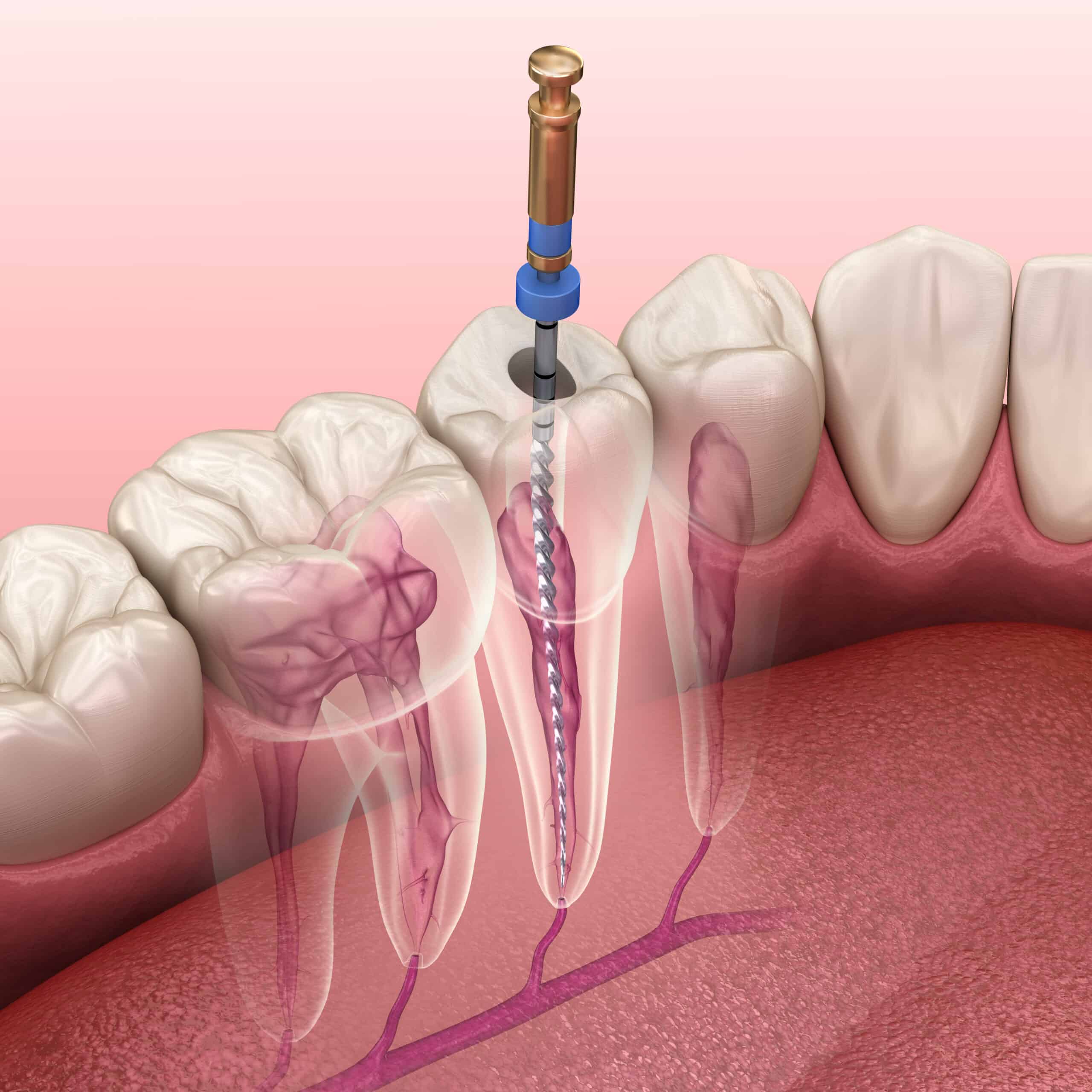 Root Canal Therapy Animated Presentation | Endodontic Specialists by Solomon Dental in Summerville, SC