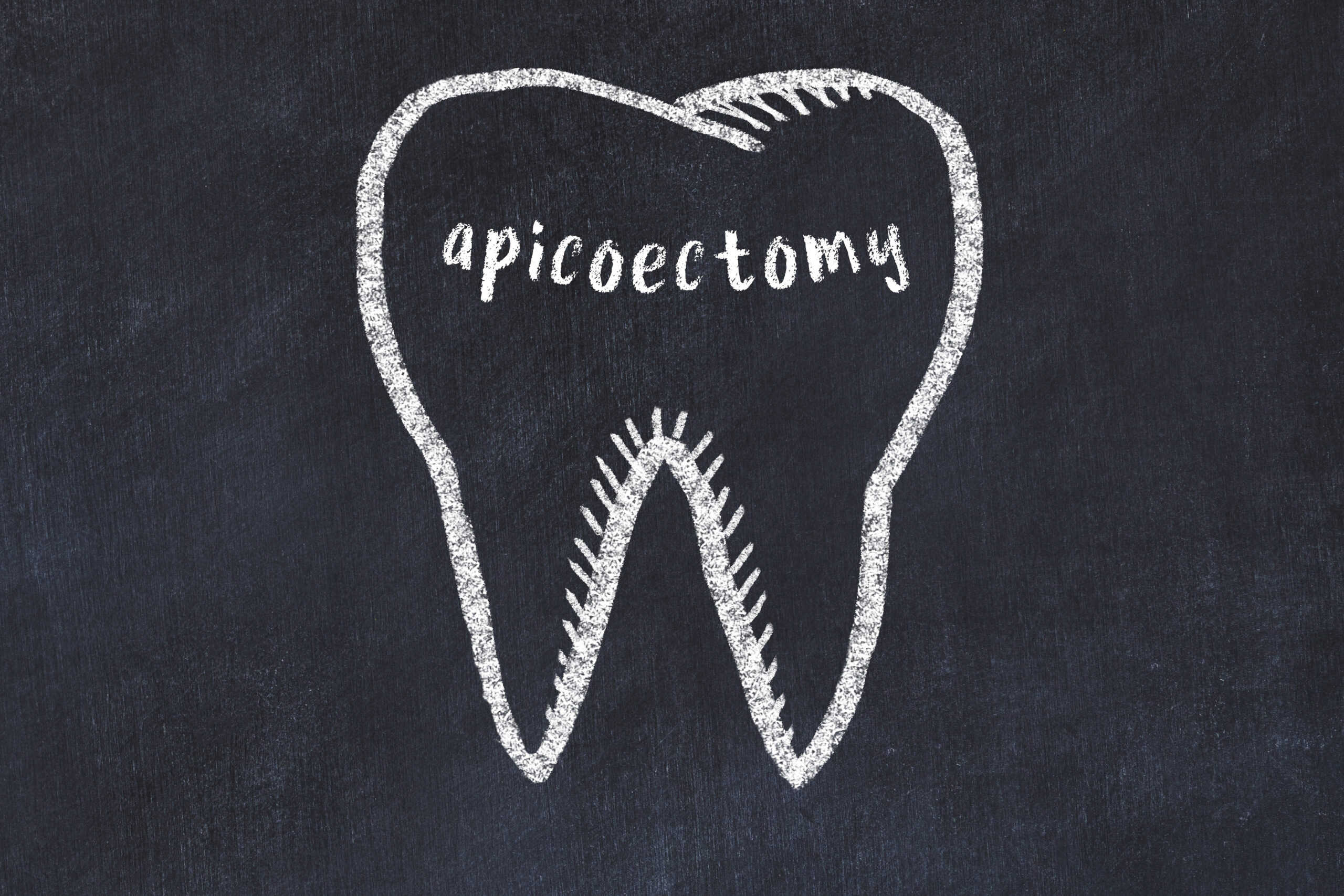 APICOECTOMY: Guide to Endodontic Surgery for Dental Health