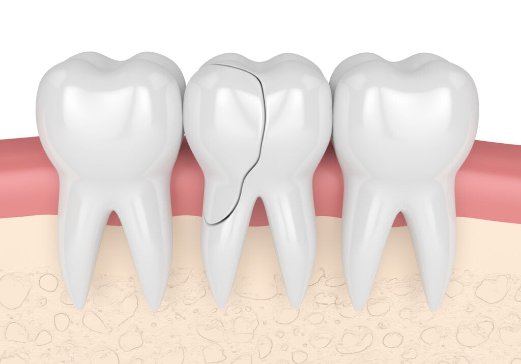 Cracked tooth: Symptoms, diagnosis, and treatment