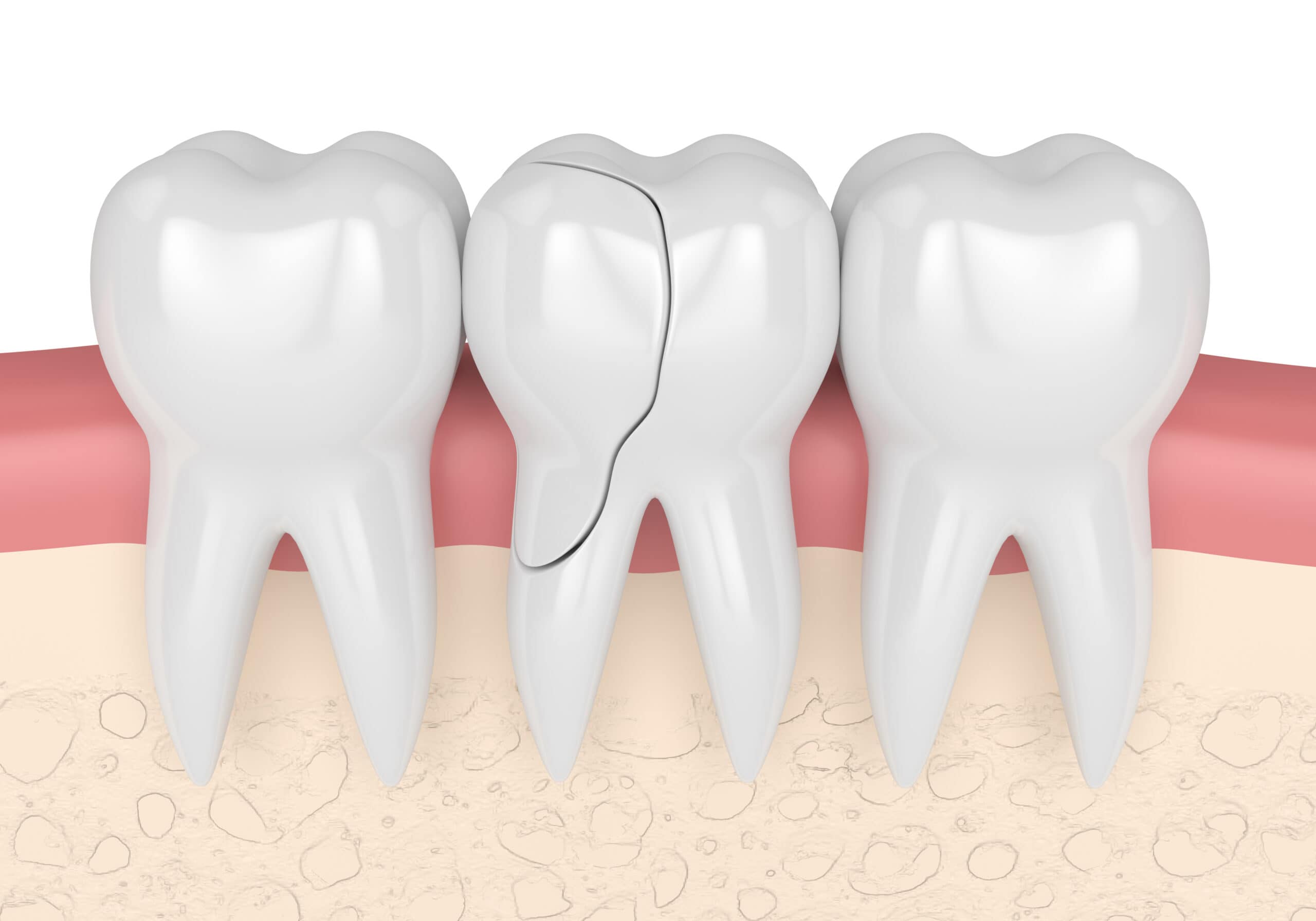 Cracked tooth Symptoms, diagnosis, and treatment