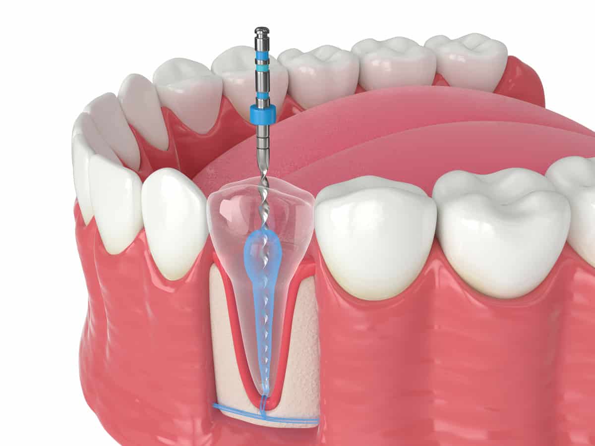 What is GentleWave Root Canal Procedure?