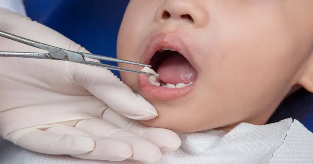 Endodontic Treatments for Children by Solomon Dental Management in Summerville, SC