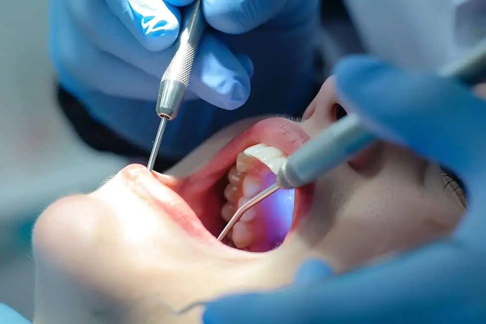 Root Canal Treatment by Solomon Dental Management in Summerville, SC